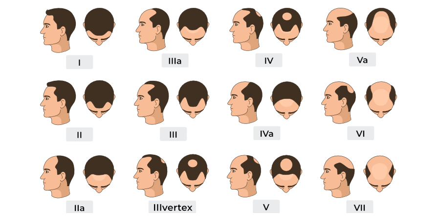 Understanding Hair Loss: Why It Happens and What Type You May Have